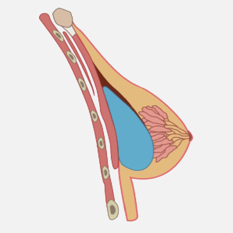 Femme Tenant Un Implant Mammaire En Silicone Pour Une Augmentation